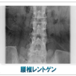 腰椎レントゲン