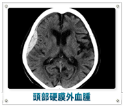 頭部硬膜外血腫