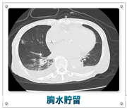 胸水貯留