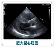 肥大型心筋症