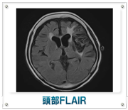 頭部FLAIR