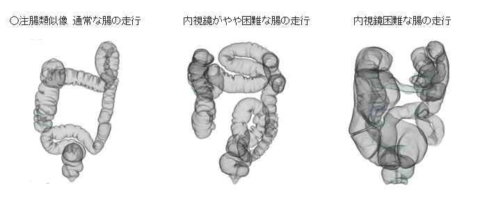 注腸類似像(通常な腸の走行・内視鏡がやや困難な腸の走行・内視鏡困難な腸の走行)